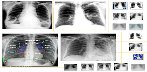 Chest X-Ray And Pathology pc screenshot