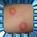Ringworm Home Treatment icon